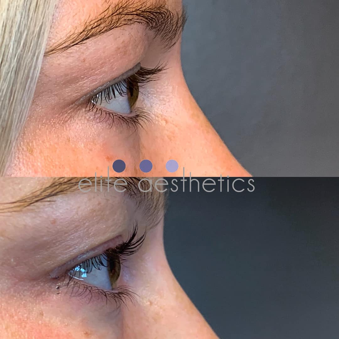 Microneedling With Prp Overland Park Kansas